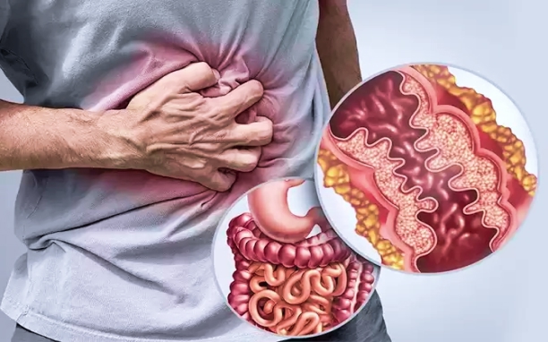 Ulcerative Colitis